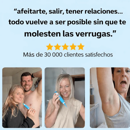 Eliminador Inteligente de Verrugas – Seguro y Preciso
